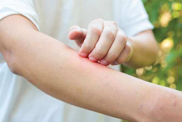 Uma pessoa coça o braço mordido por um mosquito