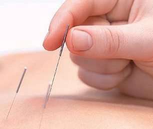 acupuntura1